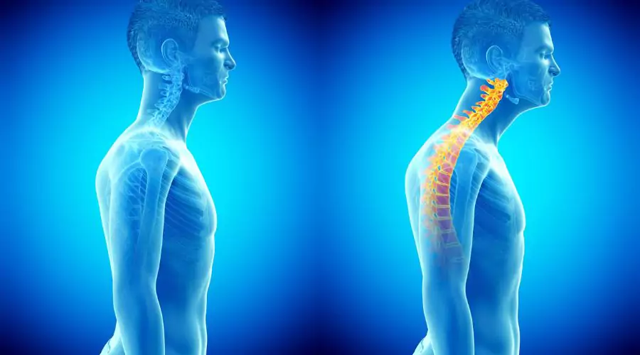 Optimal Spinal Alignment
